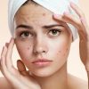7 روش خانگی برای درمان جوش صورت