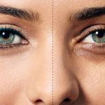 درمان سیاهی زیر چشم و عوامل ایجاد کننده آن
