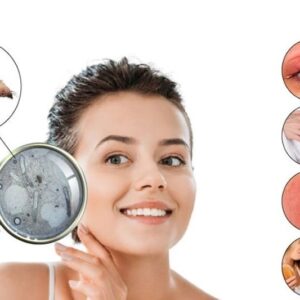 انگل دمودکس چگونه از بین میرود