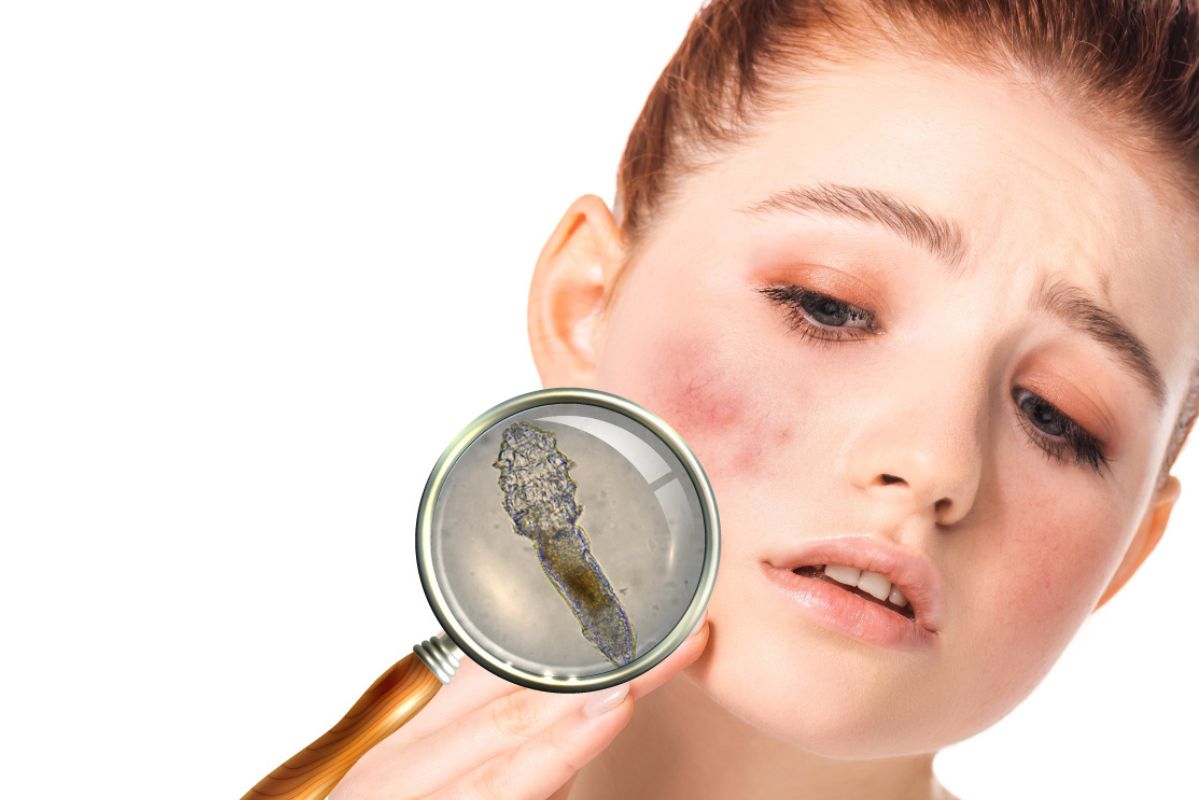 مراقبت از پوست برای جلوگیری از بازگشت انگل دمودکس