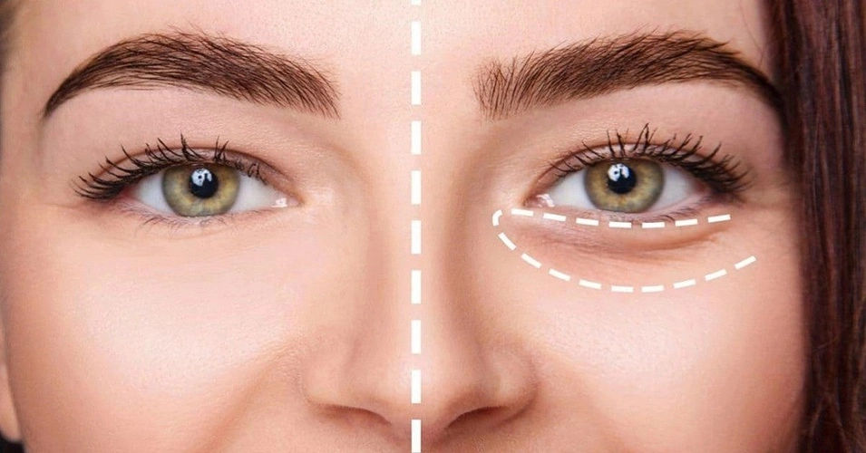 دورچشم بالای 40 سال